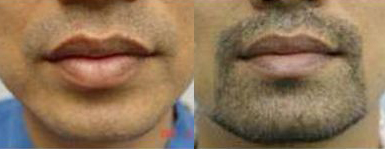 ���ݱ���Ƥ��ר��ҽԺ��ʲôʳ���ͷ����