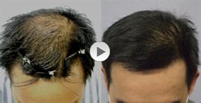 ���ݱ���Ƥ��ר��ҽԺ������ҽԺ��üë��ֲ��ó�����