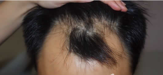 ���ݱ���Ƥ��ר��ҽԺŮ���ѷ���ʲô��