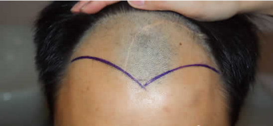 ���ݱ���Ƥ��ר��ҽԺ���ȷ��ͷ����ֲЧ���ﵽԻ��