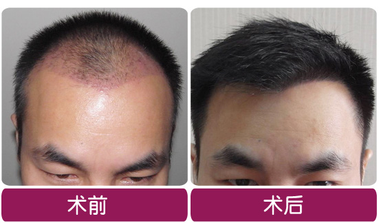 ���ݱ���Ƥ��ר��ҽԺ��С������Բ����ֲ��ë����