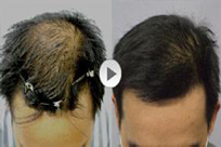 ���ݱ���Ƥ��ר��ҽԺ�����ѷ���������ô����