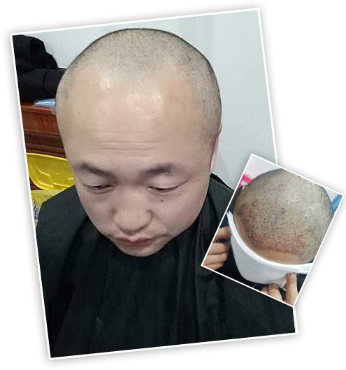 ���ݱ���Ƥ��ר��ҽԺ��ë��ֲ������ʰ��������