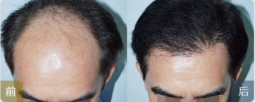 ���ݱ���Ƥ��ר��ҽԺ�ഺ���ѷ���������Ҫע��ʲô