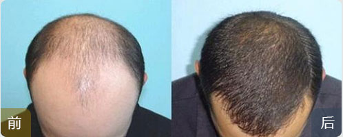 ���ݱ���Ƥ��ר��ҽԺ�޽���ֲ��Ҫ����Ǯ��